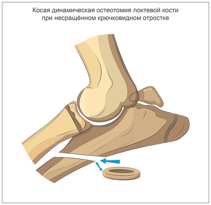 Косая динамическая остеотомия локтевой кости при несращённом крючковидном отростке